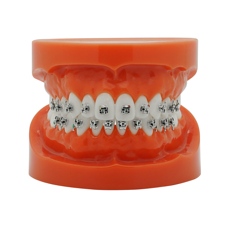 Self-ligating metal bracket (Tasuta kohaletoimetamine Eestisse) Self-ligating metal bracket (Tasuta kohaletoimetamine Eestisse)