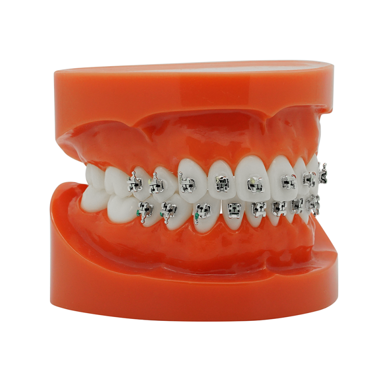 Self-ligating metal bracket (Tasuta kohaletoimetamine Eestisse) Self-ligating metal bracket (Tasuta kohaletoimetamine Eestisse)