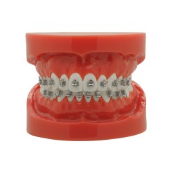 Self-ligating metal bracket (Ingyenes házhozszállítás Magyarország)