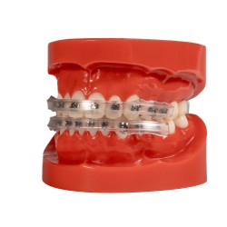 Lip Protector for brackets (2x)