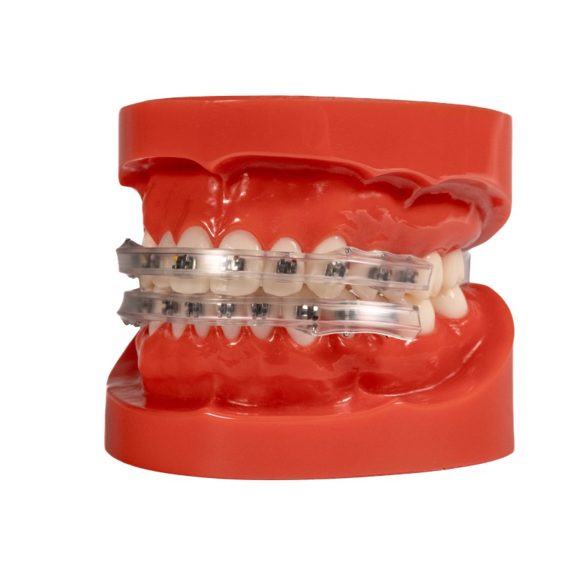 Lip Protector for brackets (2x)