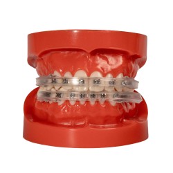 Lip Protector for brackets (2x)