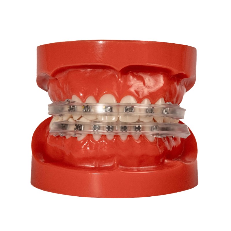 Lip Protector for brackets (2x)