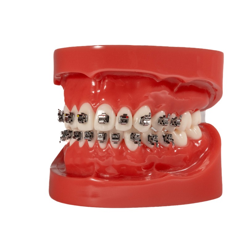 Self-ligating metal bracket (Enviament gratis a Espanya)