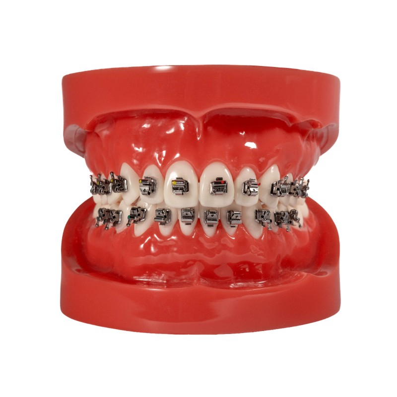 Self-ligating metal bracket (Enviament gratis a Espanya)